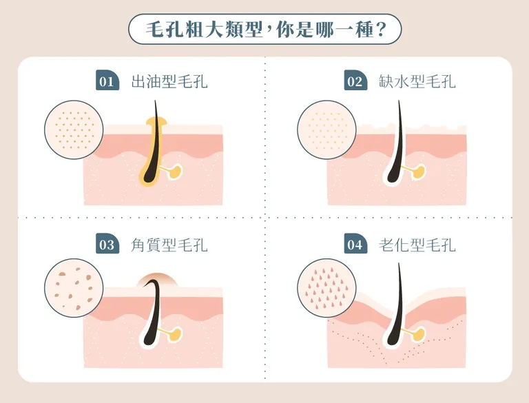 毛孔粗大 醫美療程 